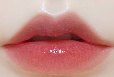 玻尿酸丰唇的优势有哪些 术后注意这些保持更久