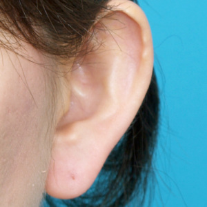 整形前后对比图片