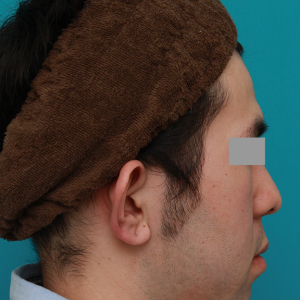 整形前后对比图片