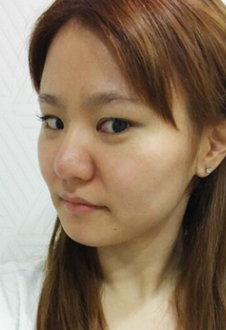 整形前后对比图片