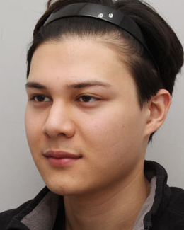 整形前后对比图片