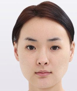 整形前后对比图片