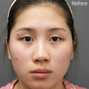 整形前后对比图片