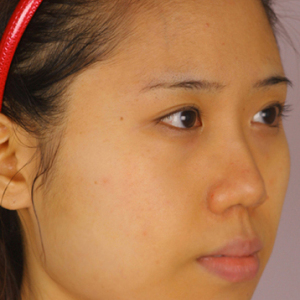 整形前后对比图片