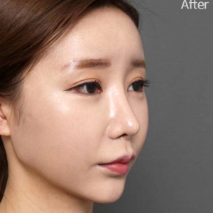 整形前后对比图片