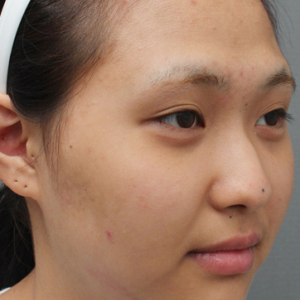 整形前后对比图片