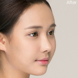 整形前后对比图片