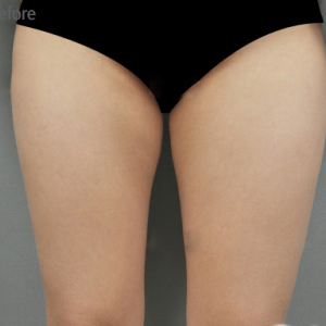 整形前后对比图片