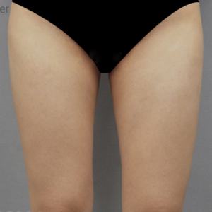 整形前后对比图片