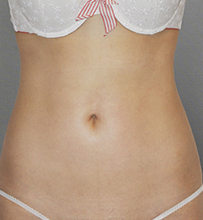 整形前后对比图片