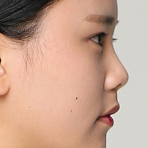 整形前后对比图片