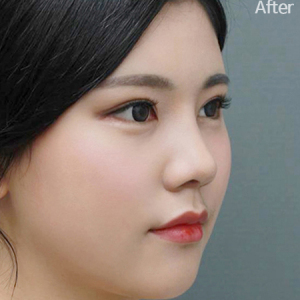 整形前后对比图片