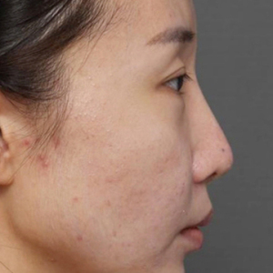 整形前后对比图片