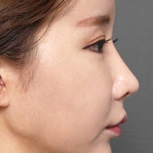 整形前后对比图片