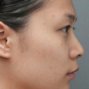 整形前后对比图片