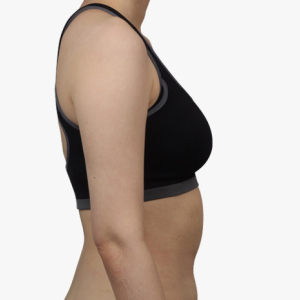 整形前后对比图片