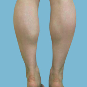 整形前后对比图片