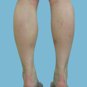 整形前后对比图片