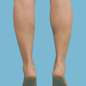 整形前后对比图片