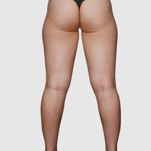 整形前后对比图片