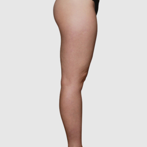 整形前后对比图片