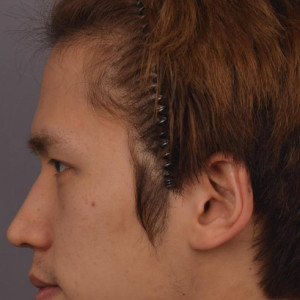 整形前后对比图片