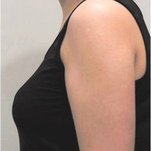 整形前后对比图片