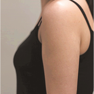 整形前后对比图片