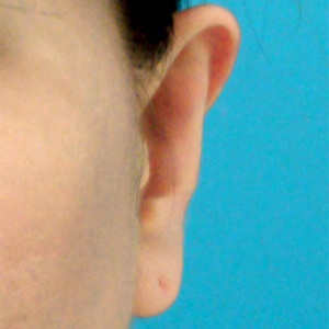 整形前后对比图片