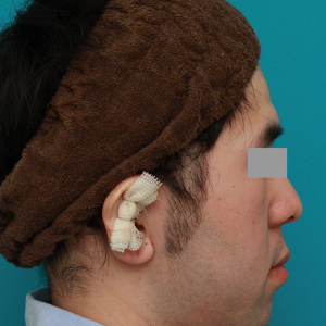 整形前后对比图片