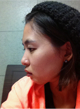 整形前后对比图片