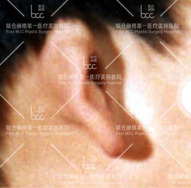 整形前后对比图片