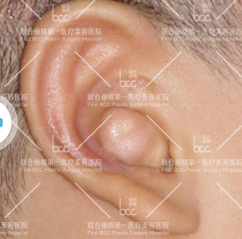 整形前后对比图片