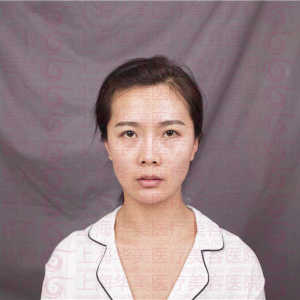 整形前后对比图片