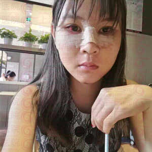 整形前后对比图片