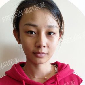 整形前后对比图片