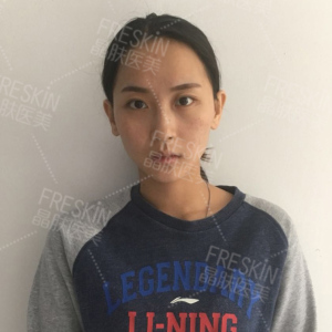 整形前后对比图片