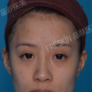 整形前后对比图片