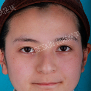 整形前后对比图片