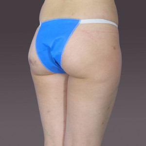 整形前后对比图片