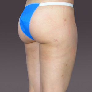 整形前后对比图片