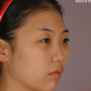 整形前后对比图片