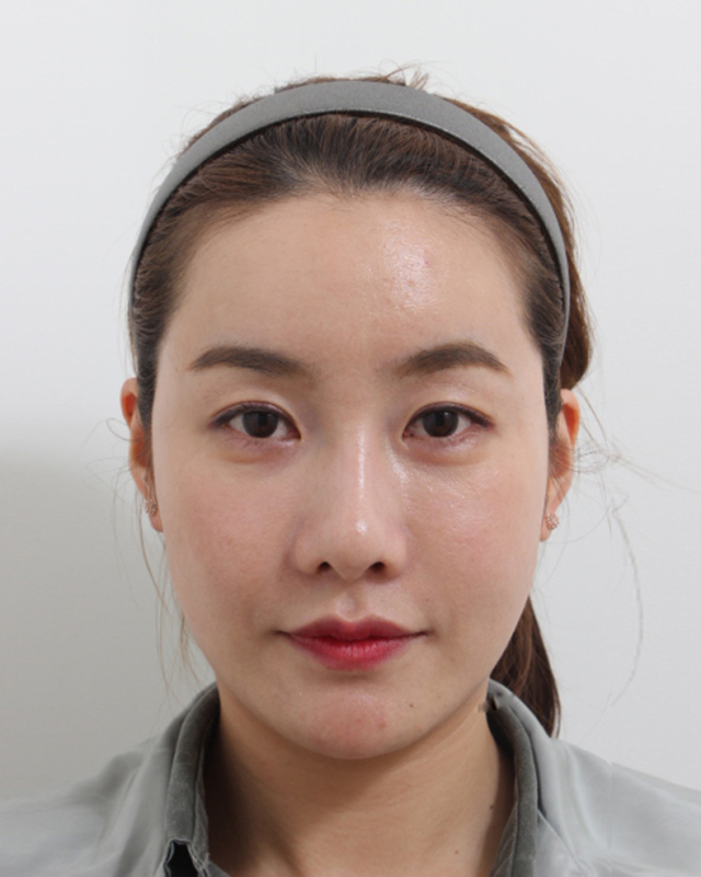 梁馒凤的整形术后图片