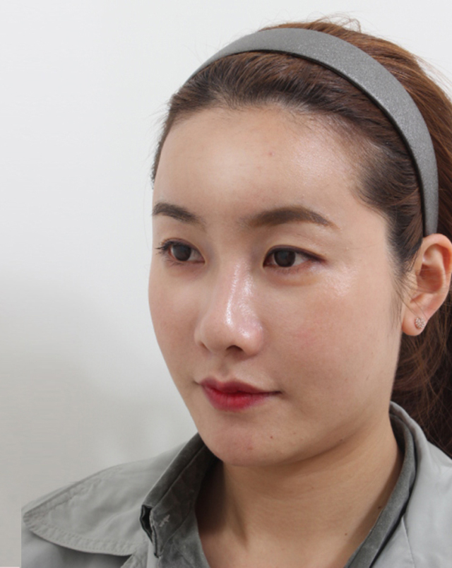 梁馒凤的整形术后图片