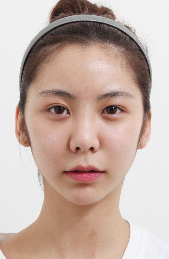 蔡晓晴的整形术后图片