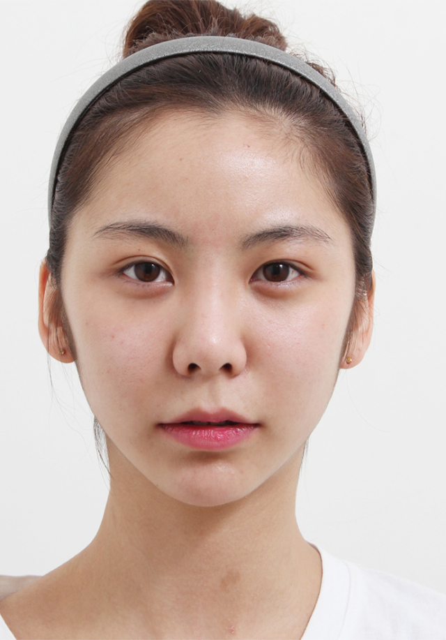 蔡晓晴的整形术后图片