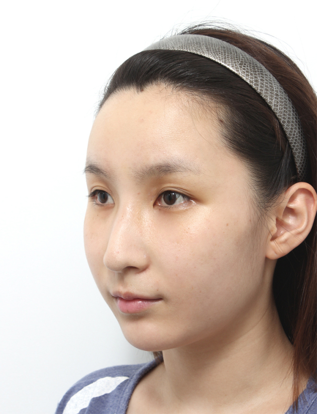 嘉嘉的整形术后图片