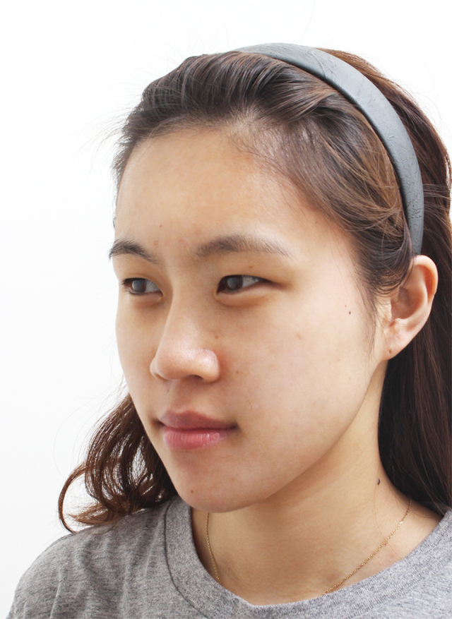 嘉嘉的整形术后图片