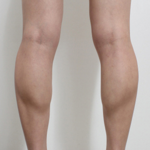 整形前后对比图片