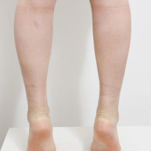 整形前后对比图片